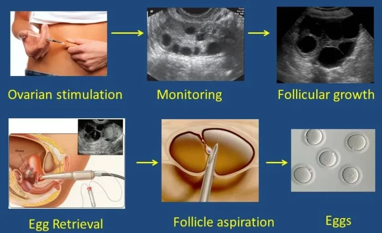 What Is IVF And How Much Does It Cost In Delhi